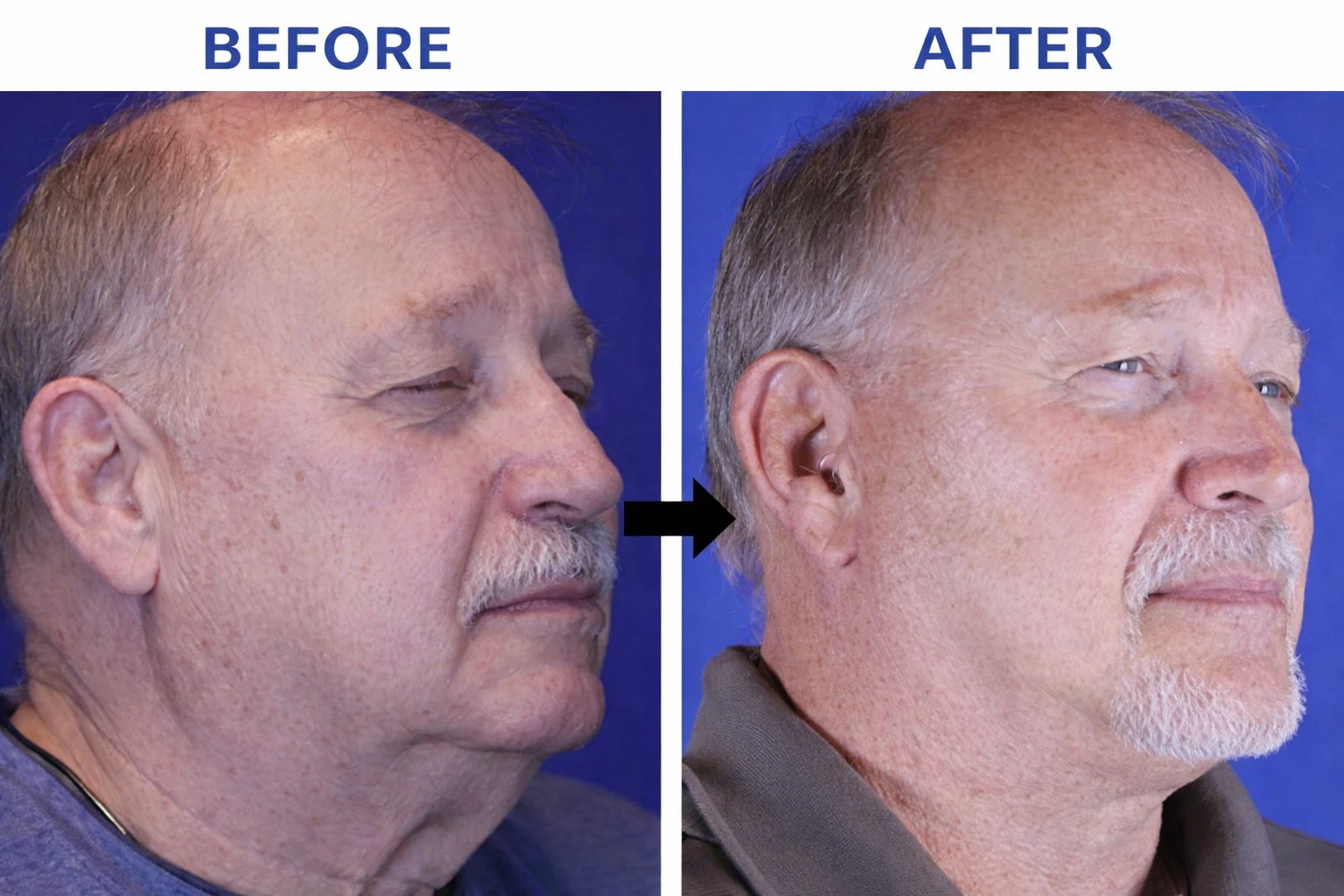 OptiPlax Natural before-after